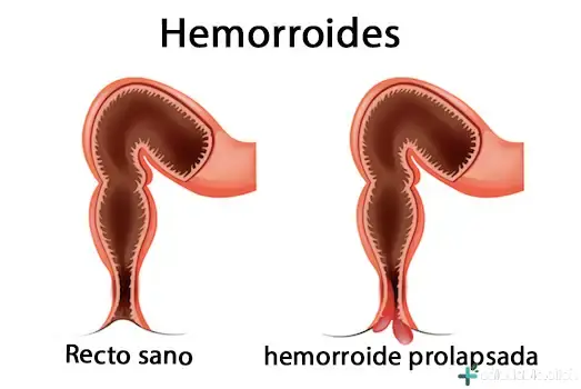 ¿Qué Son las Hemorroides?