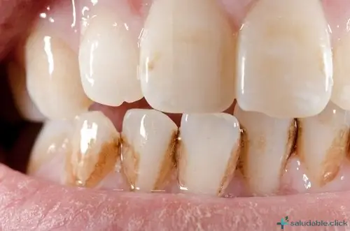 Cómo quitar el sarro de los dientes de forma natural